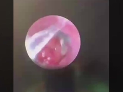 バターフライ ENT 手術器具 ENT 探査機