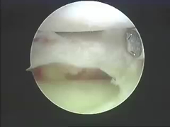 脊柱および接合箇所のためのElectrosurgicalの器械の切除システム切除プロダクト