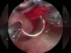 クール技術 血球外科 尿科 BPH 治療用電極