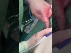 診療所 肝病検知器 PLA408 オープン手術用